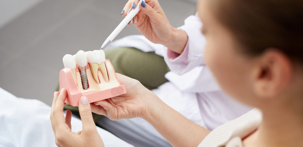 Implantes dentários são uma boa escolha?