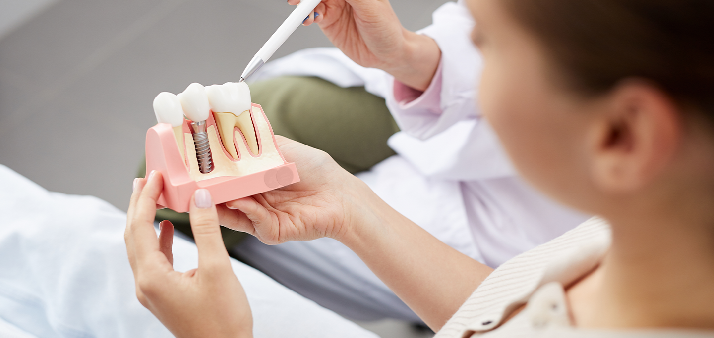 5 benefícios dos implantes dentários 